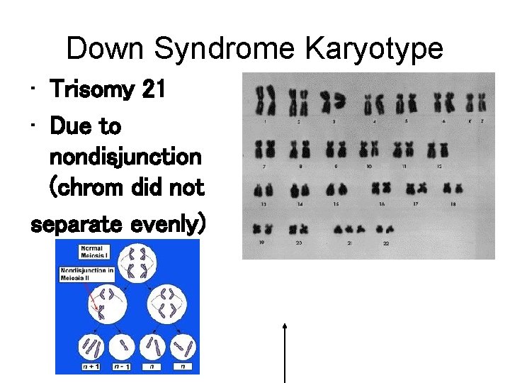 Down Syndrome Karyotype • Trisomy 21 • Due to nondisjunction (chrom did not separate