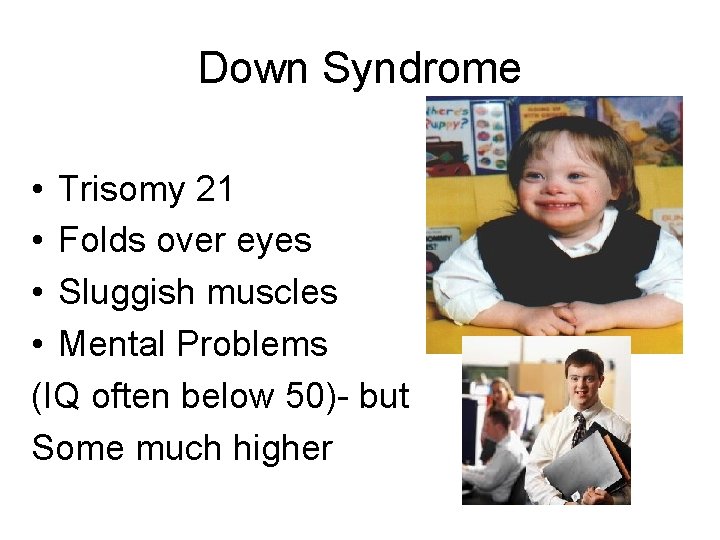 Down Syndrome • Trisomy 21 • Folds over eyes • Sluggish muscles • Mental