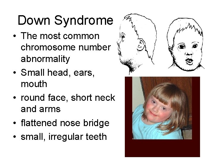 Down Syndrome • The most common chromosome number abnormality • Small head, ears, mouth