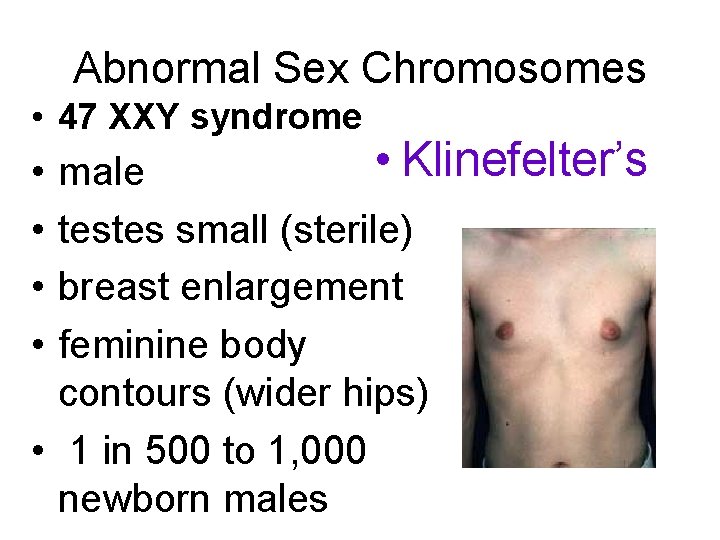 Abnormal Sex Chromosomes • 47 XXY syndrome • Klinefelter’s male testes small (sterile) breast