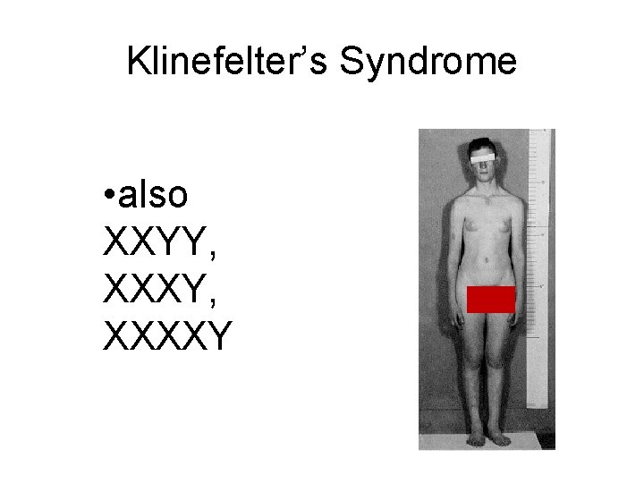 Klinefelter’s Syndrome • also XXYY, XXXXY 