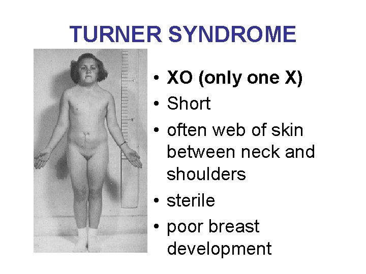 TURNER SYNDROME • XO (only one X) • Short • often web of skin