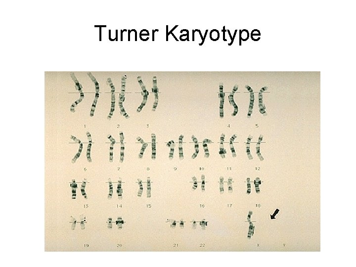 Turner Karyotype 