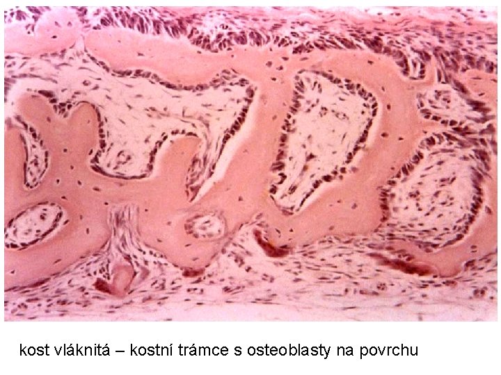 kost vláknitá – kostní trámce s osteoblasty na povrchu 