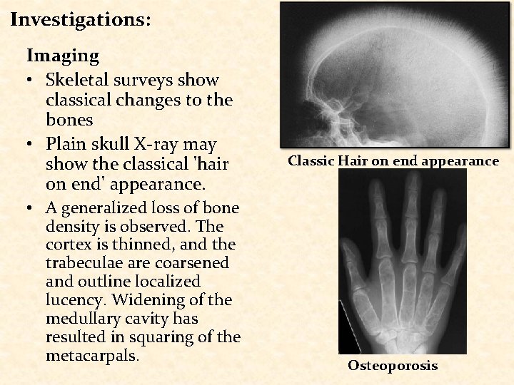 Investigations: Imaging • Skeletal surveys show classical changes to the bones • Plain skull