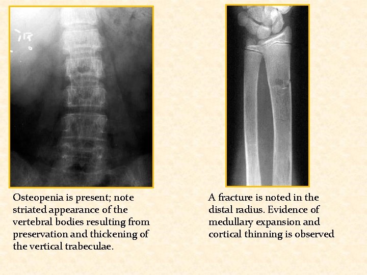 Osteopenia is present; note striated appearance of the vertebral bodies resulting from preservation and