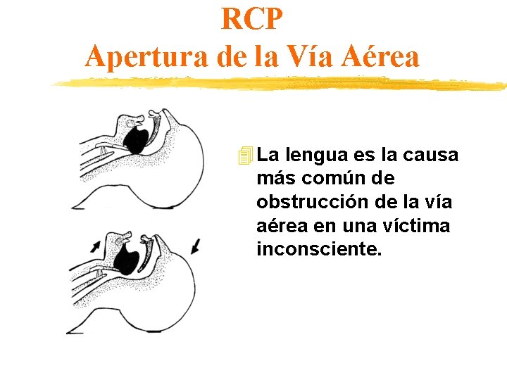 RCP Apertura de la Vía Aérea 4 La lengua es la causa más común