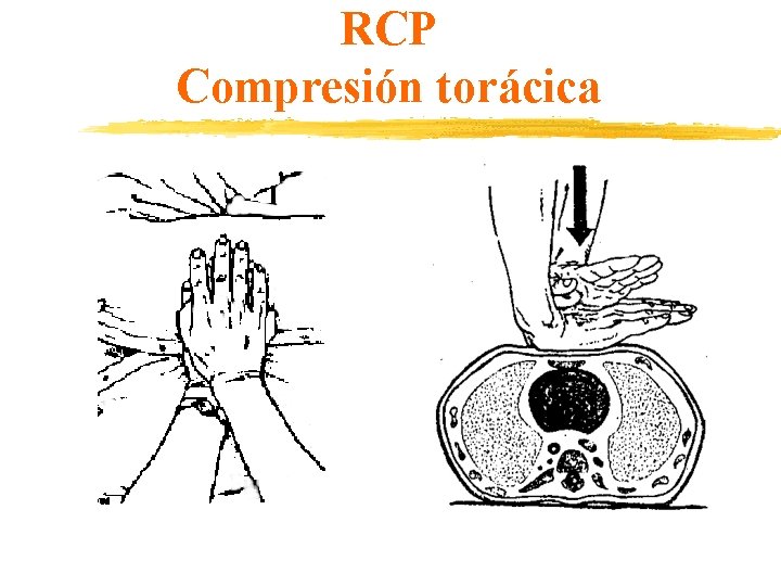 RCP Compresión torácica 