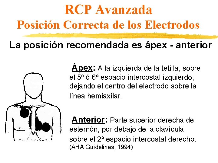 RCP Avanzada Posición Correcta de los Electrodos La posición recomendada es ápex - anterior