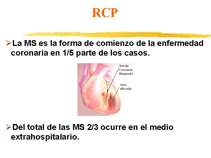 RCP ØLa MS es la forma de comienzo de la enfermedad coronaria en 1/5