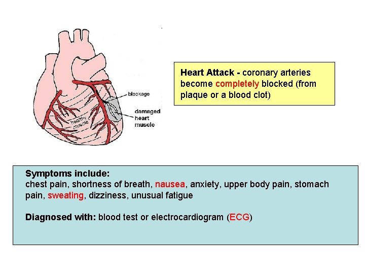 Heart Attack - coronary arteries become completely blocked (from plaque or a blood clot)