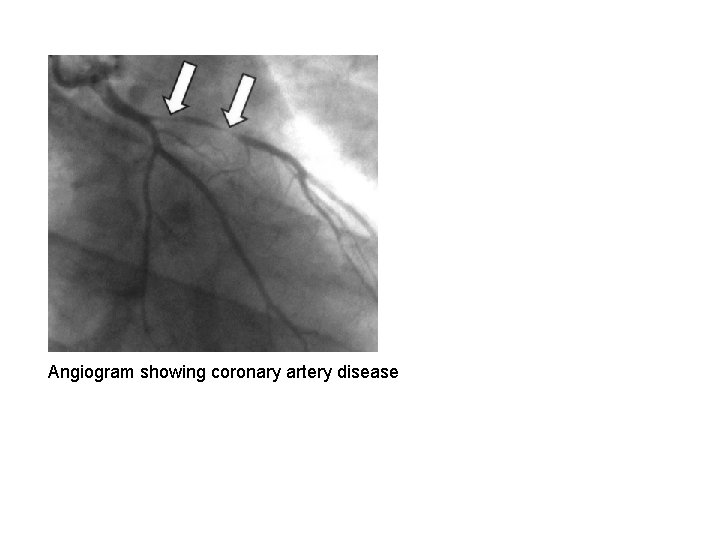 Angiogram showing coronary artery disease 