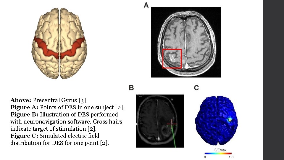 Above: Precentral Gyrus [3] Figure A: Points of DES in one subject [2]. Figure