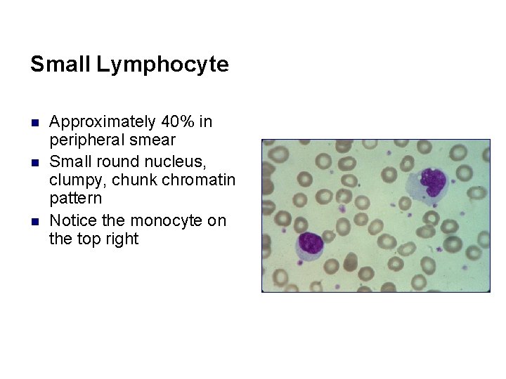 Small Lymphocyte n n n Approximately 40% in peripheral smear Small round nucleus, clumpy,