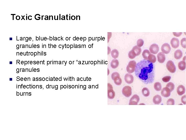 Toxic Granulation n Large, blue-black or deep purple granules in the cytoplasm of neutrophils