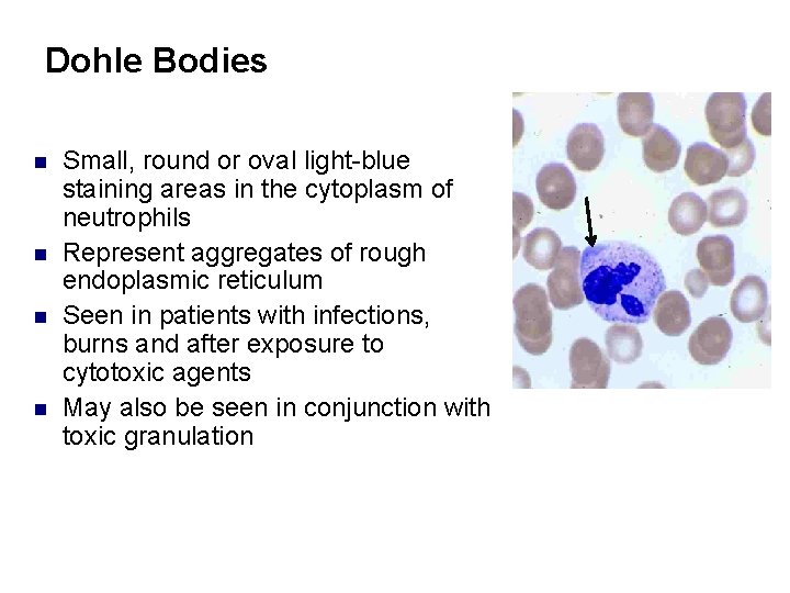 Dohle Bodies n n Small, round or oval light-blue staining areas in the cytoplasm