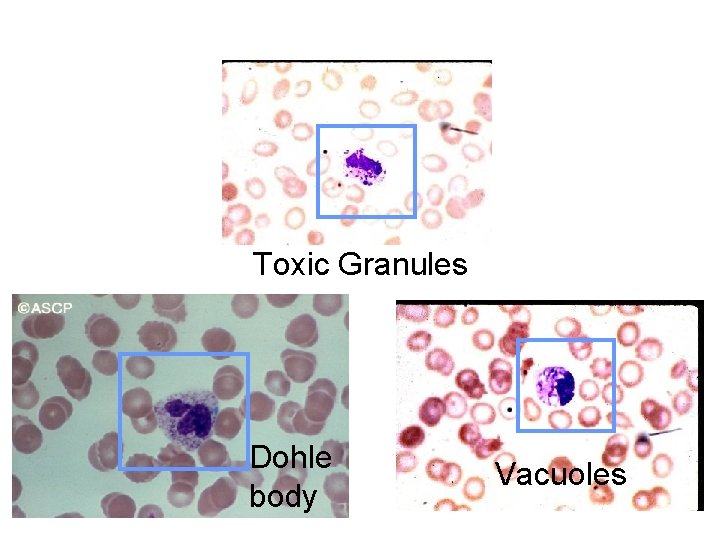 Toxic Granules Dohle body Vacuoles 