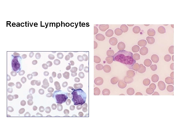 Reactive Lymphocytes 