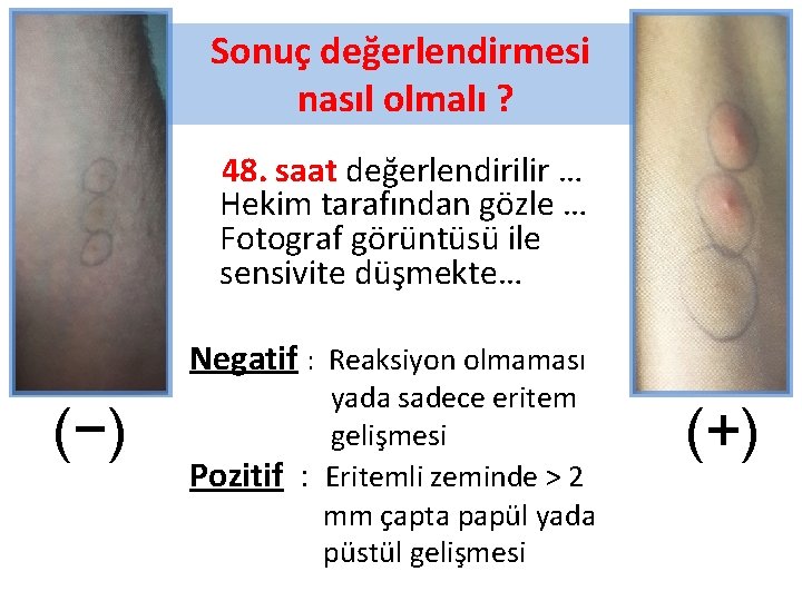 Sonuç değerlendirmesi nasıl olmalı ? 48. saat değerlendirilir … Hekim tarafından gözle … Fotograf