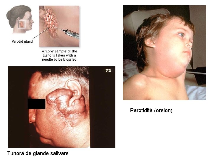 Parotidită (oreion) Tunoră de glande salivare 