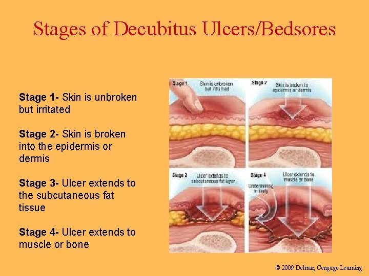 Stages of Decubitus Ulcers/Bedsores Stage 1 - Skin is unbroken but irritated Stage 2