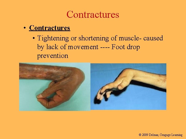 Contractures • Tightening or shortening of muscle- caused by lack of movement ---- Foot