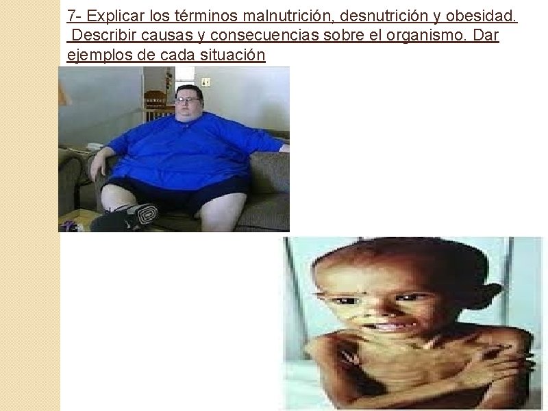 7 - Explicar los términos malnutrición, desnutrición y obesidad. Describir causas y consecuencias sobre