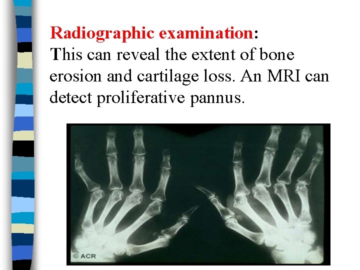 Radiographic examination: This can reveal the extent of bone erosion and cartilage loss. An