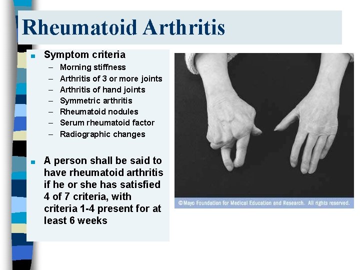 Rheumatoid Arthritis ■ Symptom criteria – – – – ■ Morning stiffness Arthritis of