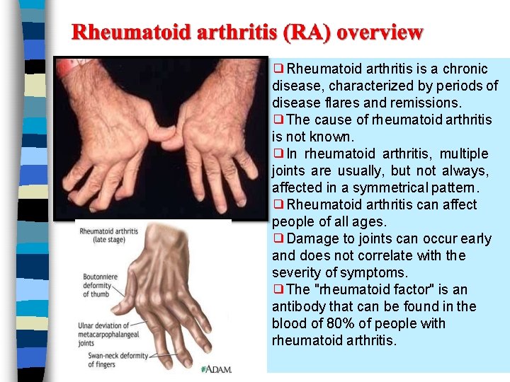 ❑Rheumatoid arthritis is a chronic disease, characterized by periods of disease flares and remissions.