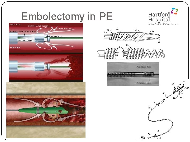 Embolectomy in PE 