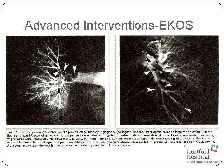 Advanced Interventions-EKOS 