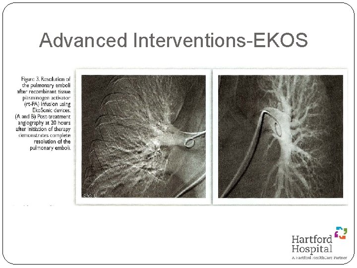 Advanced Interventions-EKOS 