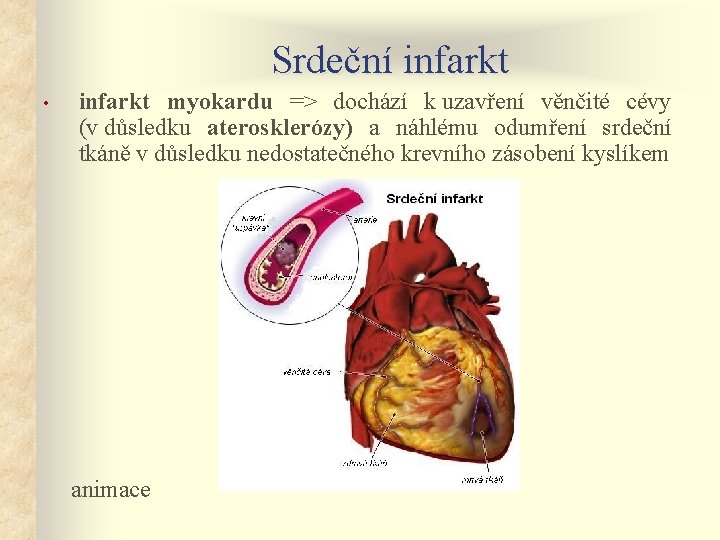 Srdeční infarkt • infarkt myokardu => dochází k uzavření věnčité cévy (v důsledku aterosklerózy)