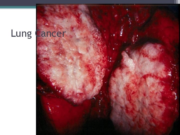 Lung Cancer 