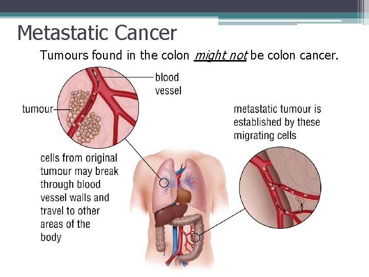 Metastatic Cancer Tumours found in the colon might not be colon cancer. 