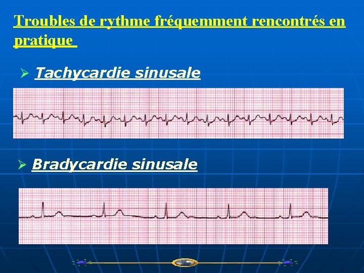 Troubles de rythme fréquemment rencontrés en pratique Ø Tachycardie sinusale Ø Bradycardie sinusale 