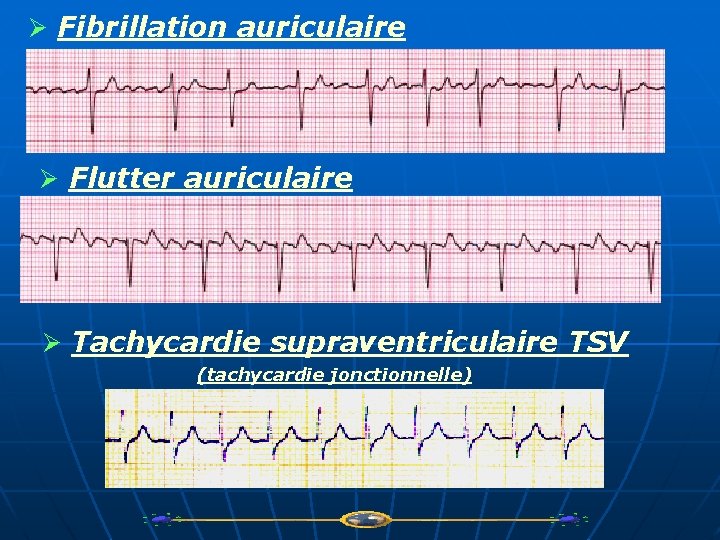 Ø Fibrillation auriculaire Ø Flutter auriculaire Ø Tachycardie supraventriculaire TSV (tachycardie jonctionnelle) 