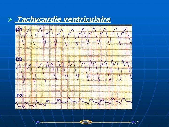 Ø Tachycardie ventriculaire 