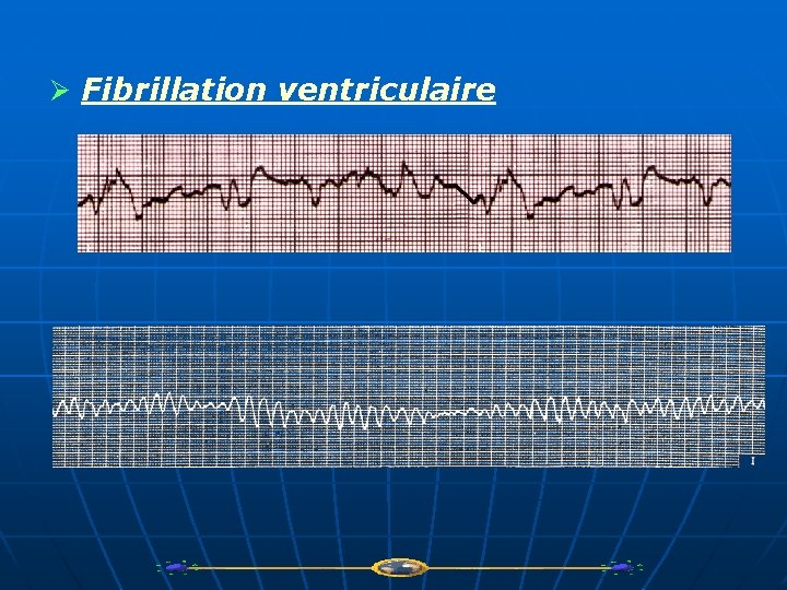 Ø Fibrillation ventriculaire 