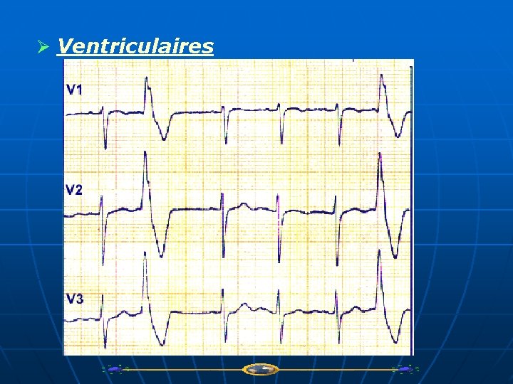Ø Ventriculaires 