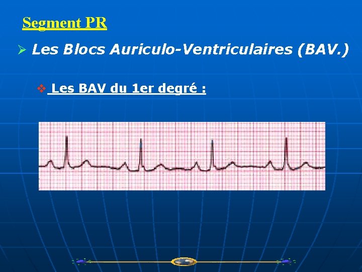 Segment PR Ø Les Blocs Auriculo-Ventriculaires (BAV. ) v Les BAV du 1 er