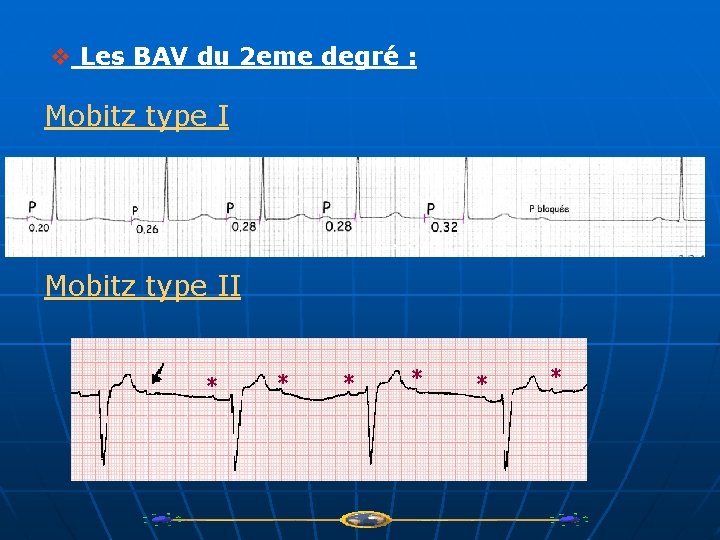 v Les BAV du 2 eme degré : Mobitz type II * * *
