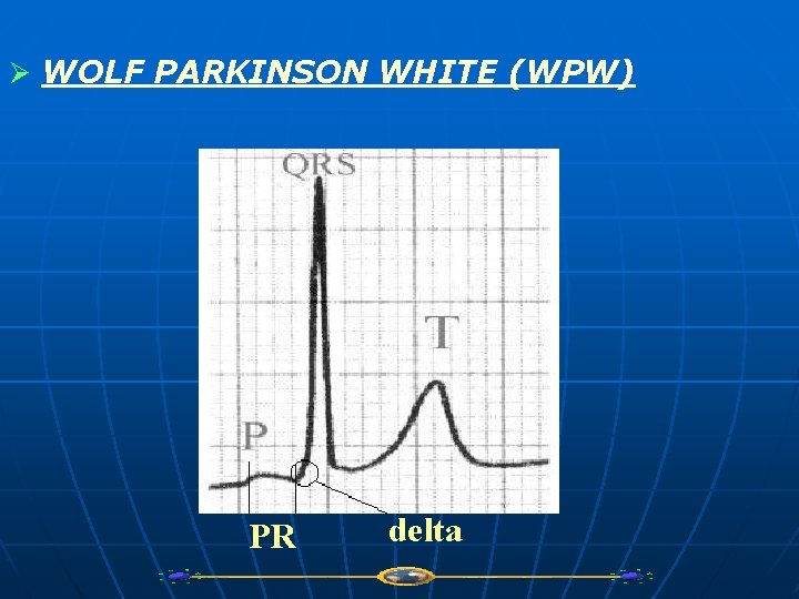 Ø WOLF PARKINSON WHITE (WPW) PR delta 