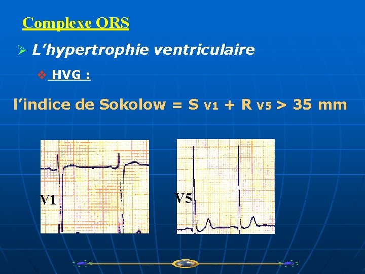 Complexe QRS Ø L’hypertrophie ventriculaire v HVG : l’indice de Sokolow = S V