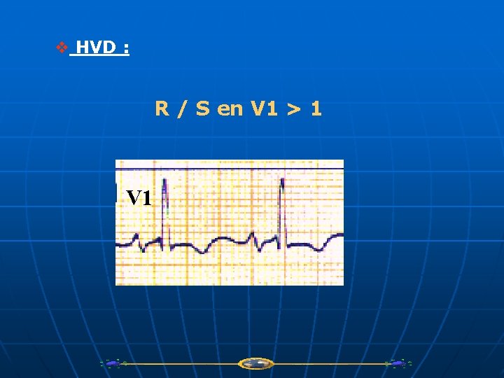 v HVD : R / S en V 1 > 1 V 1 