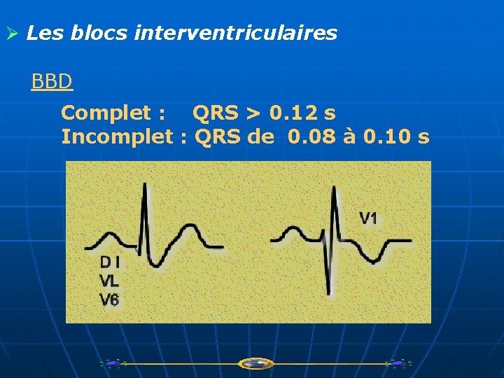 Ø Les blocs interventriculaires BBD Complet : QRS > 0. 12 s Incomplet :