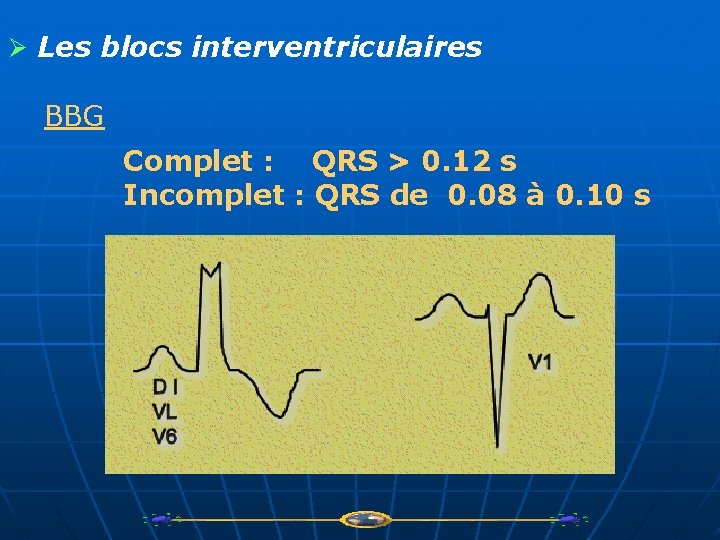 Ø Les blocs interventriculaires BBG Complet : QRS > 0. 12 s Incomplet :