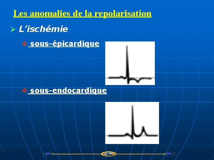 Les anomalies de la repolarisation Ø L’ischémie v sous-épicardique v sous-endocardique 