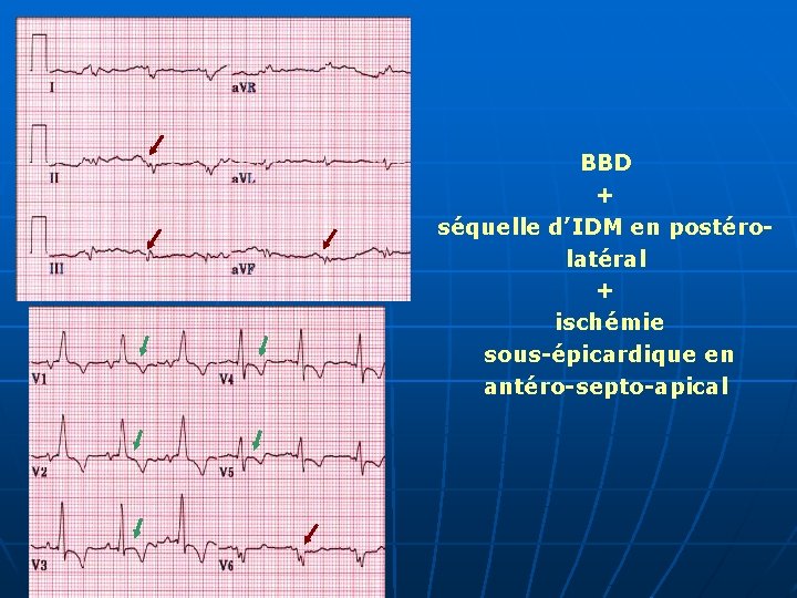 BBD + séquelle d’IDM en postérolatéral + ischémie sous-épicardique en antéro-septo-apical 